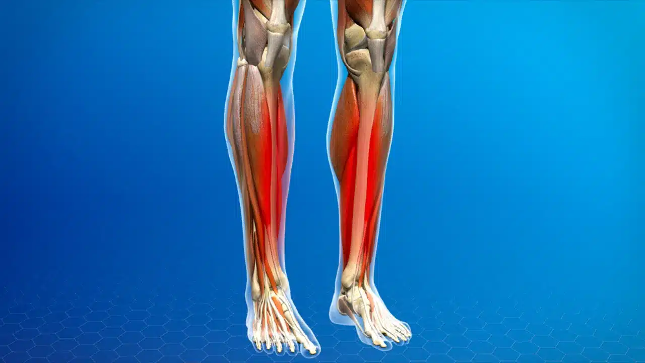 shinsplints 1280