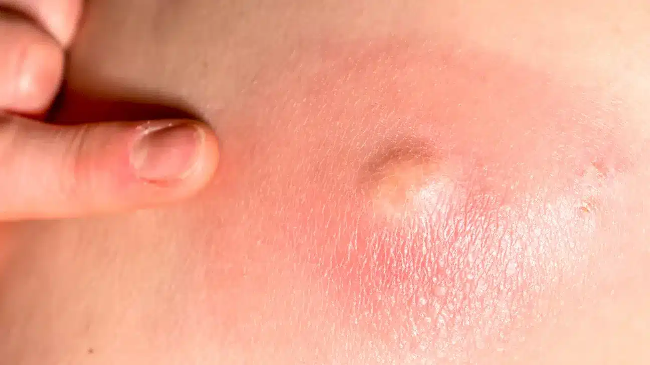 skin abscess 1296x728 gallery slide5