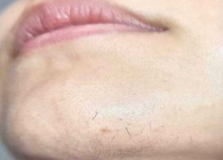 Αν είστε γυναίκα με γένια στο σαγόνι να τι σημαίνει για εσάς