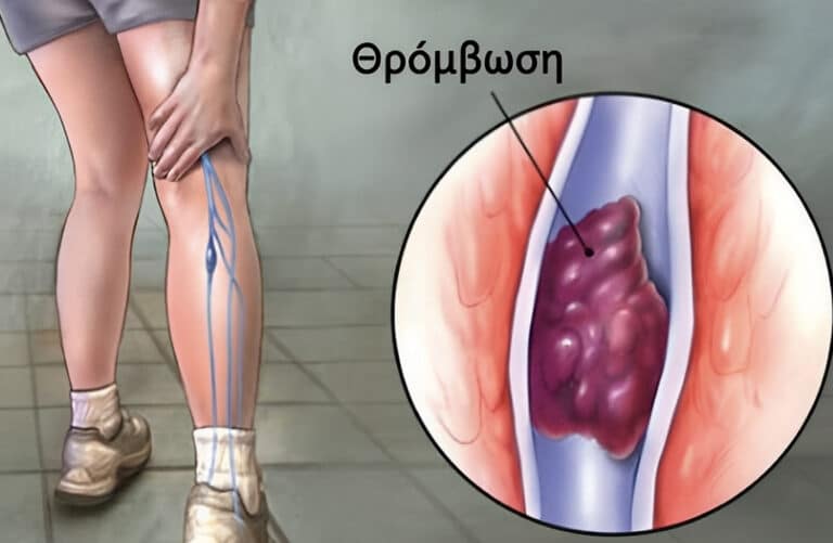 7 τρόποι για να προλάβετε τη θρόμβωση