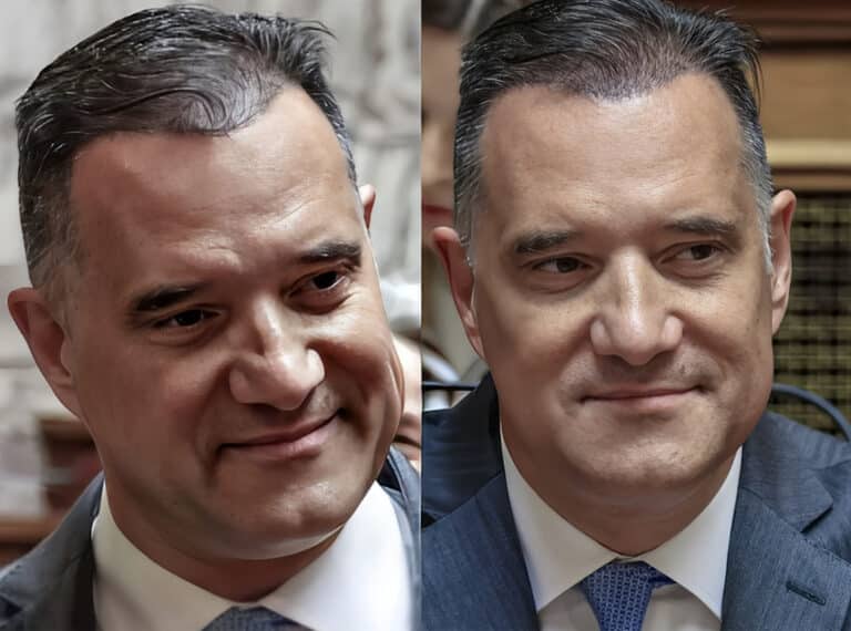 Ο Άδωνις παραδέχθηκε ότι έκανε μεταμόσχεuση μαλλιών: «Είχα μία αραίωση, είμαι ευχαριστημένος τώρα»