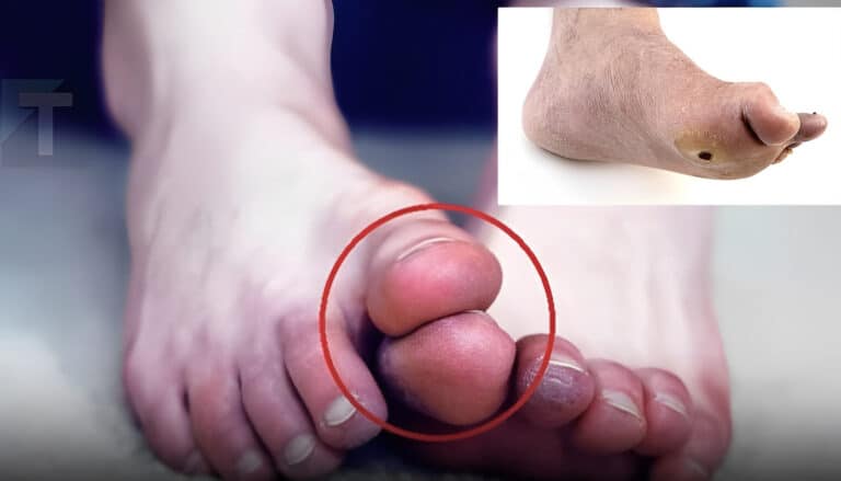 Τα πόδια σας είναι ένας «μετρητής σακχάρου στο αίμα» Προσοχή στον διαβήτη αν εμφανίζετε συχνά αυτά τα 5 παράξενα συμπτώματα