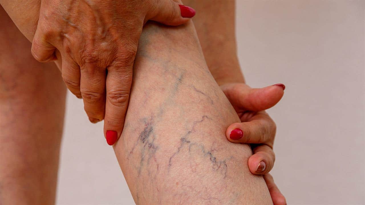 123205 veins31280