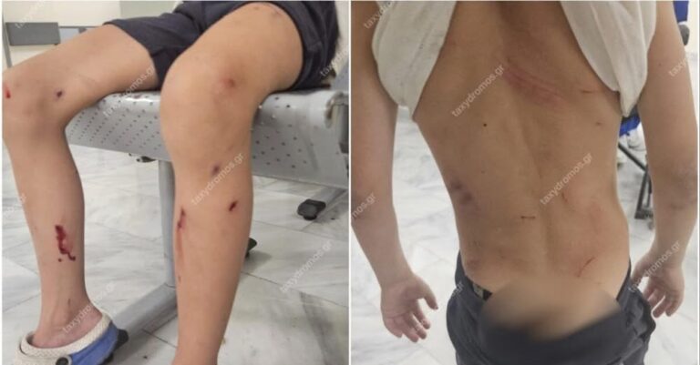 Βόλος: Στο νοσοκομείο 7χρονος μετά από επίθεση σκυλιών – «Παραλίγο να το κατασπαράξουν» λέει η μητέρα του