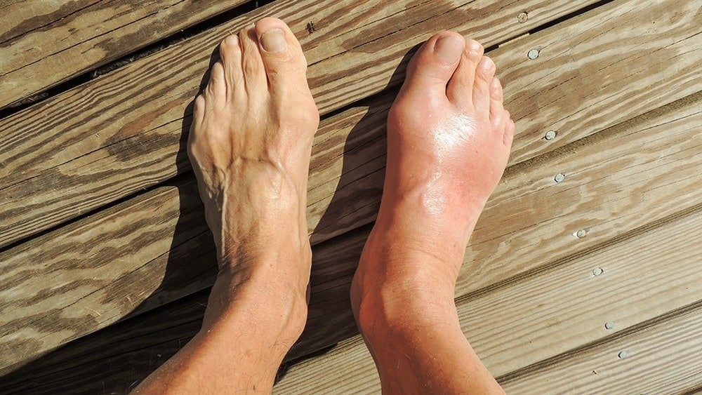 affc gout