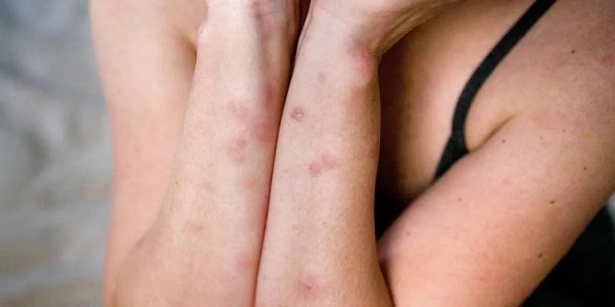 bed bugs.jpg antigrafo