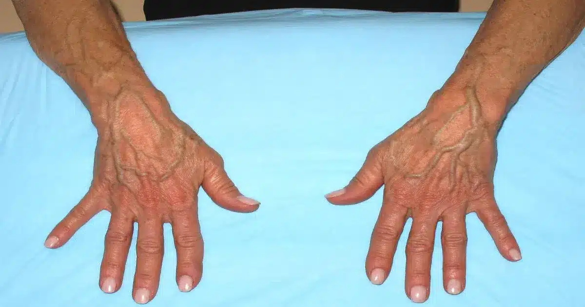 bulging veins in hands