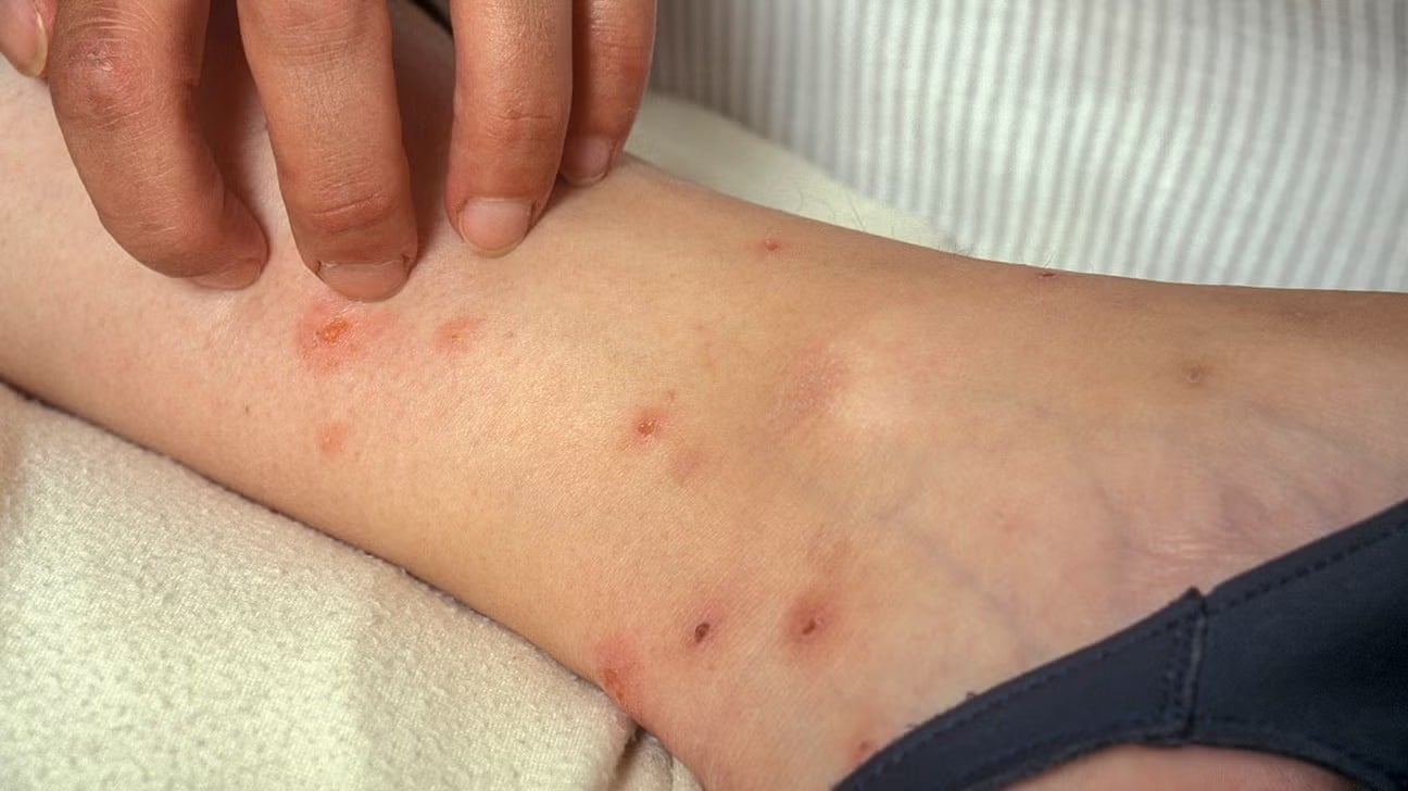 flea bites 1296x728 gallery slide3 3 11zon