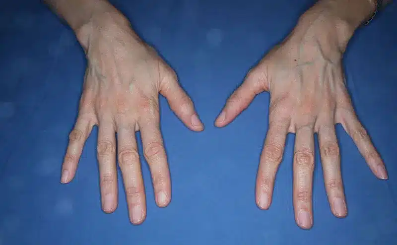hand veins before