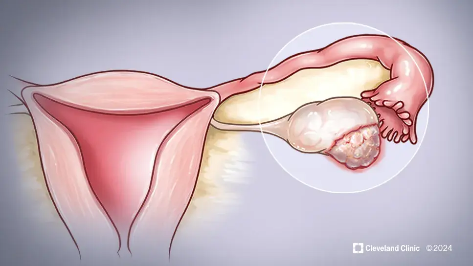 ovarian ca case study cqd 24 whi 5294410