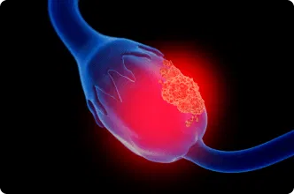 ovarian cancer closeup