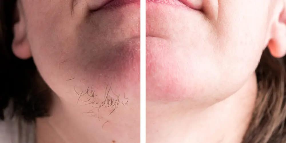 remove female chin hair 1000x500 1