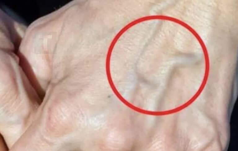 Πότε να ανησυχείτε για τις φλέβες που εμφανίζονται ξαφνικά