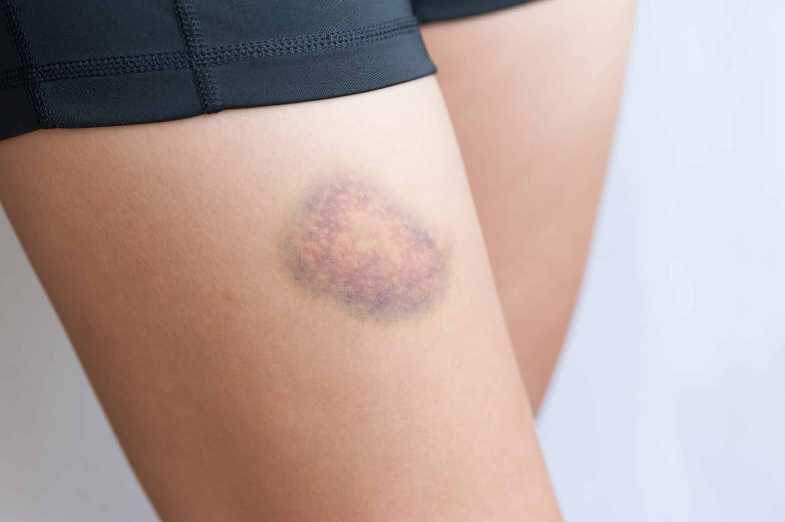 0921 bruising rheumatoid arthritis scaled 1