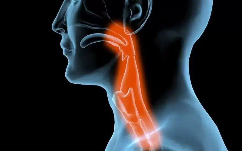 185080 635971468781426781 983899871 dysphagia 60535