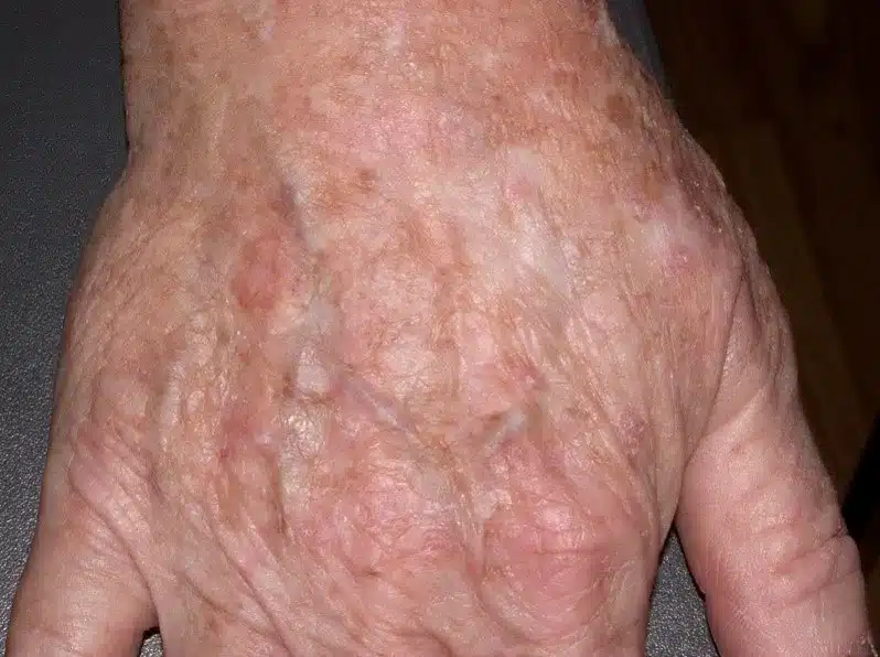 20230720 actinic keratoses hand