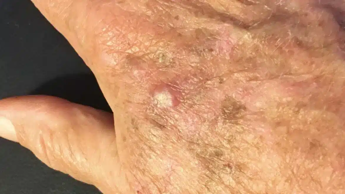 actinic keratosis 1170x658 1