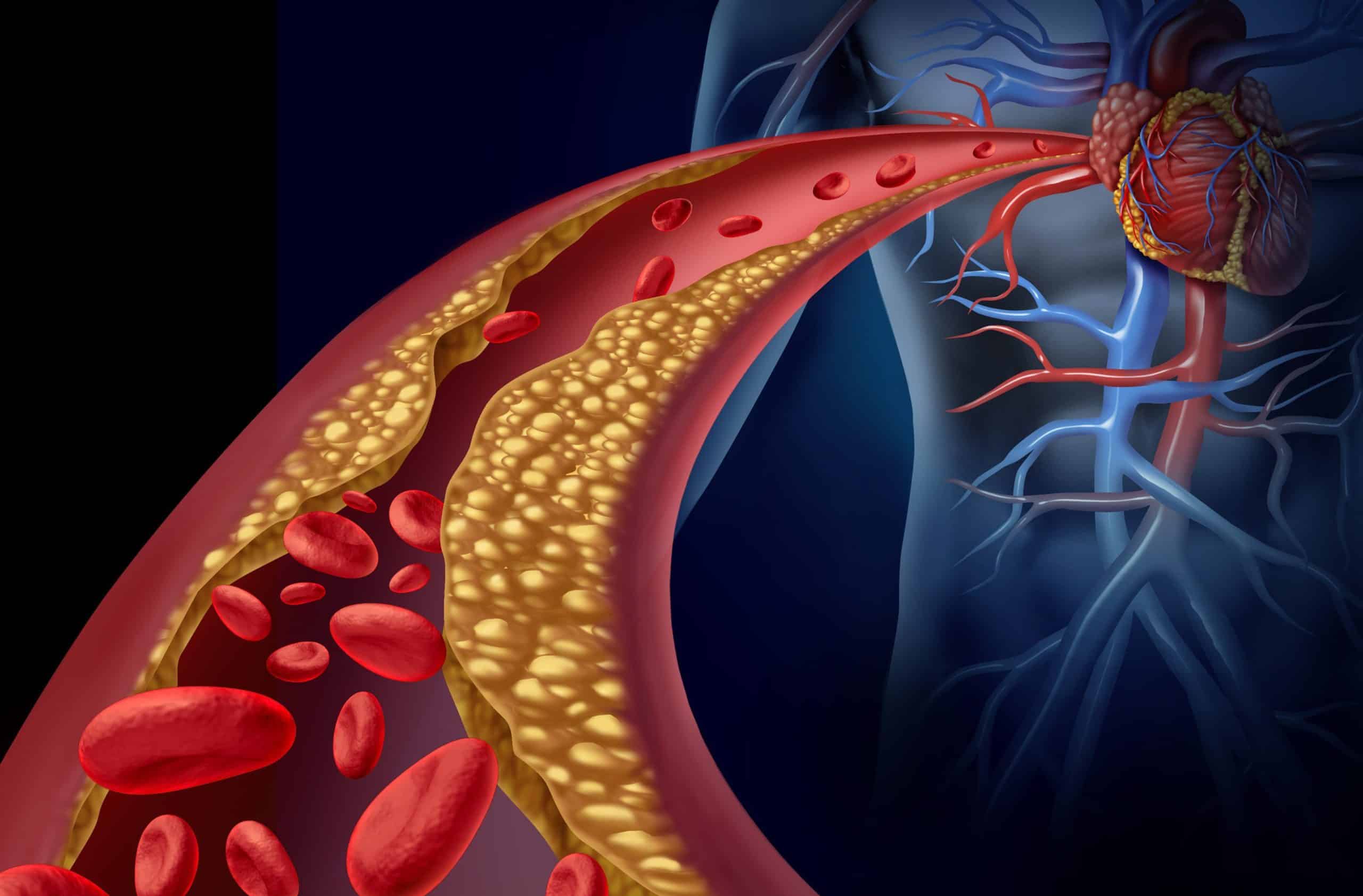 cholesterol istock 498686795 e1565872118594 scaled 1