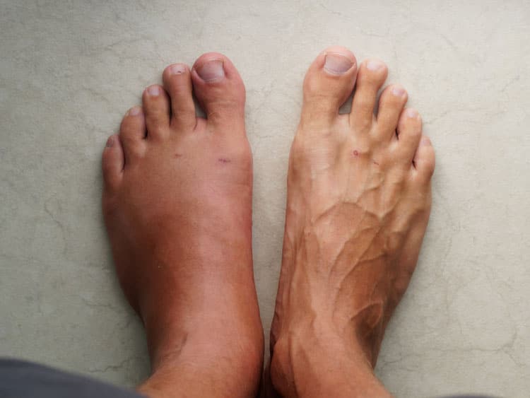 foot swelling