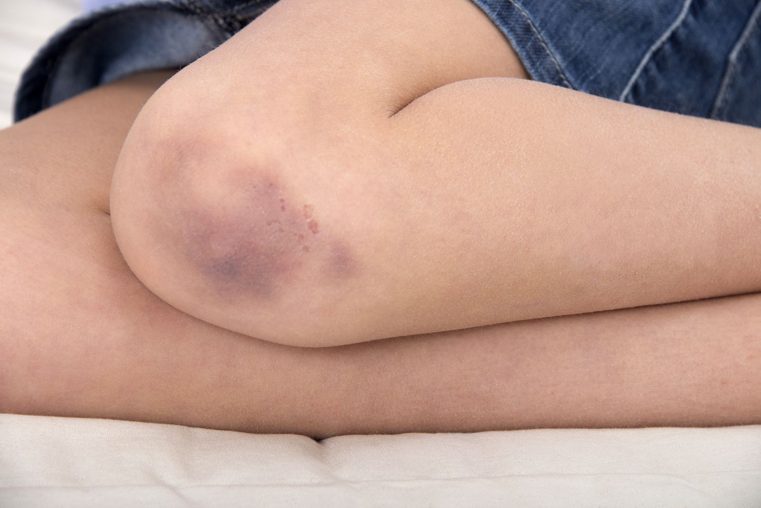 girl with a bruised knee 585107377 594468a05f9b58d58a681b3b