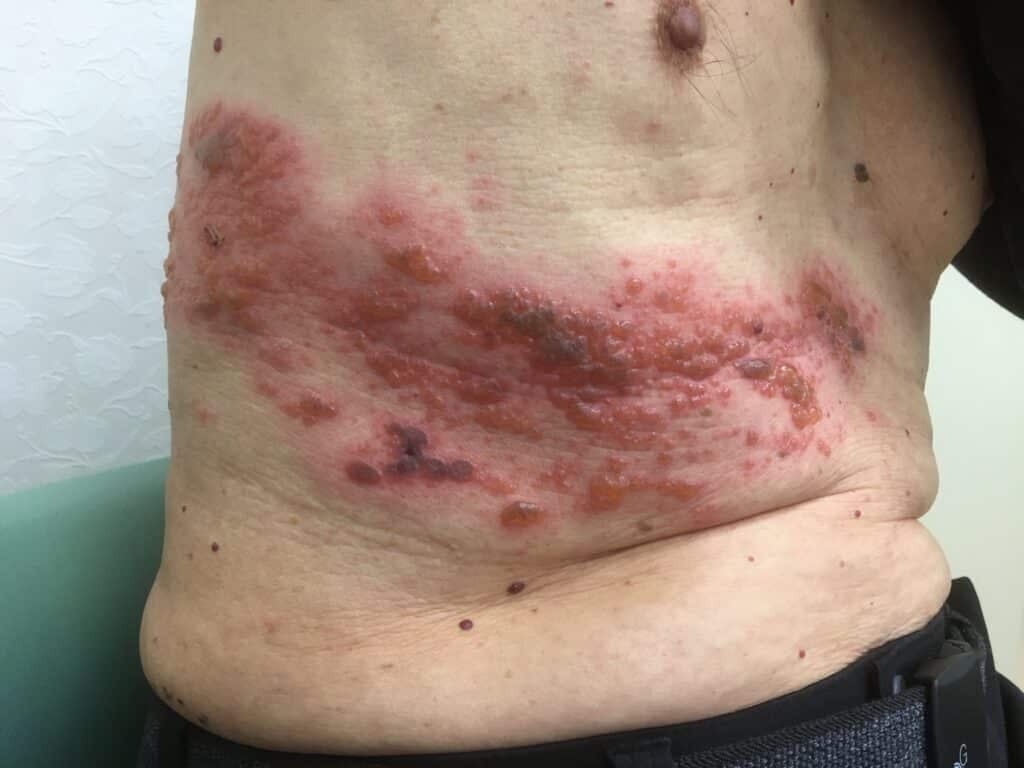herpes zoster 3days passed 1024x768 1