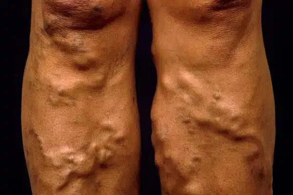 m2900055 varicose veins on a woman s legs be.max 600x600 1