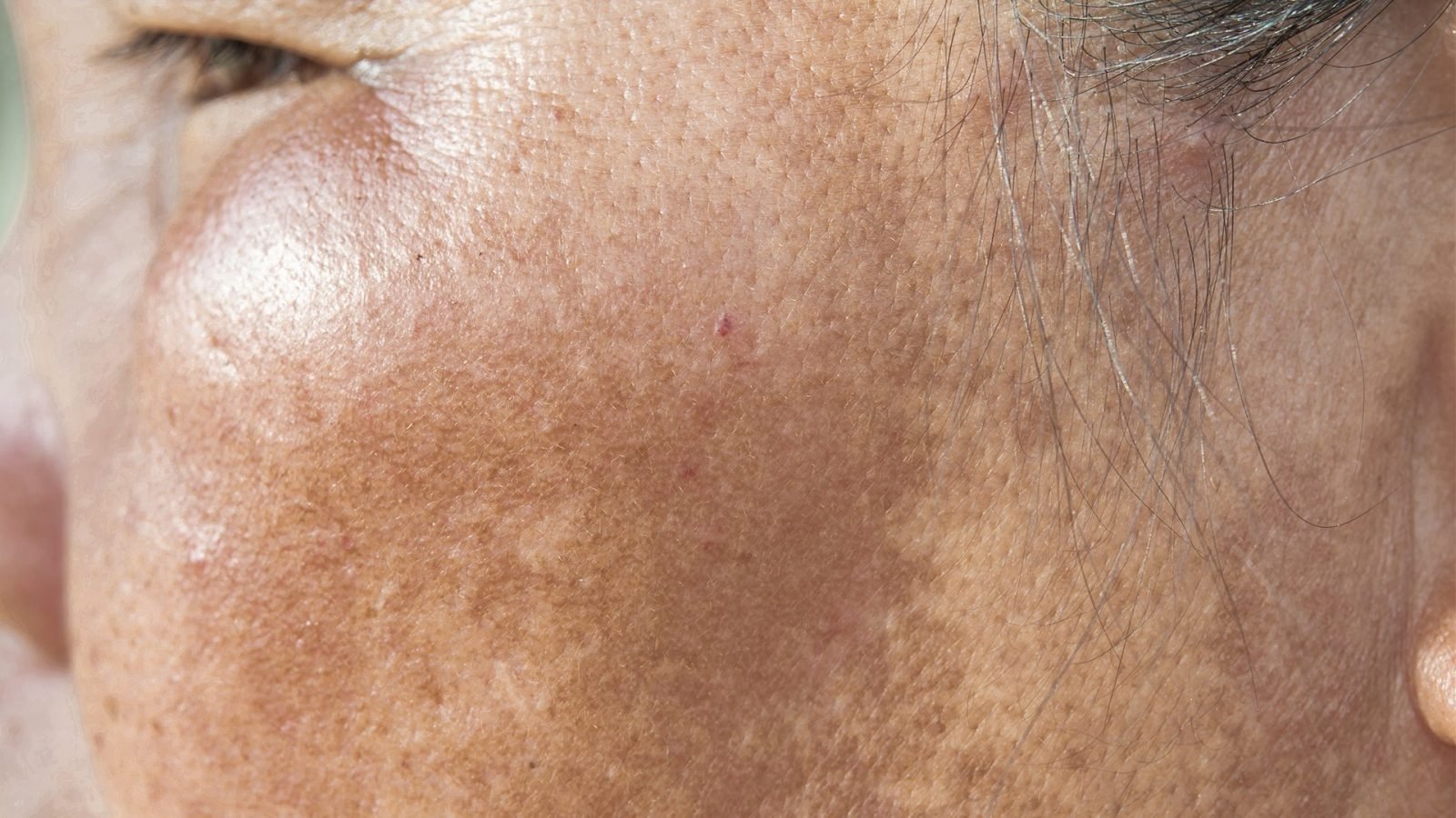 melasma 1600x900 1