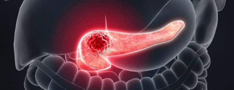 pancreatic cancer