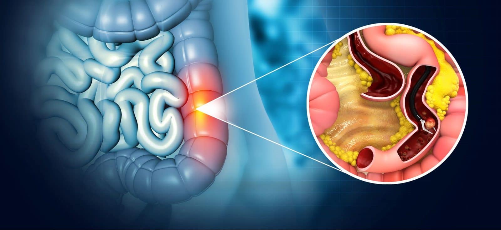 polyps colon e1689618678665
