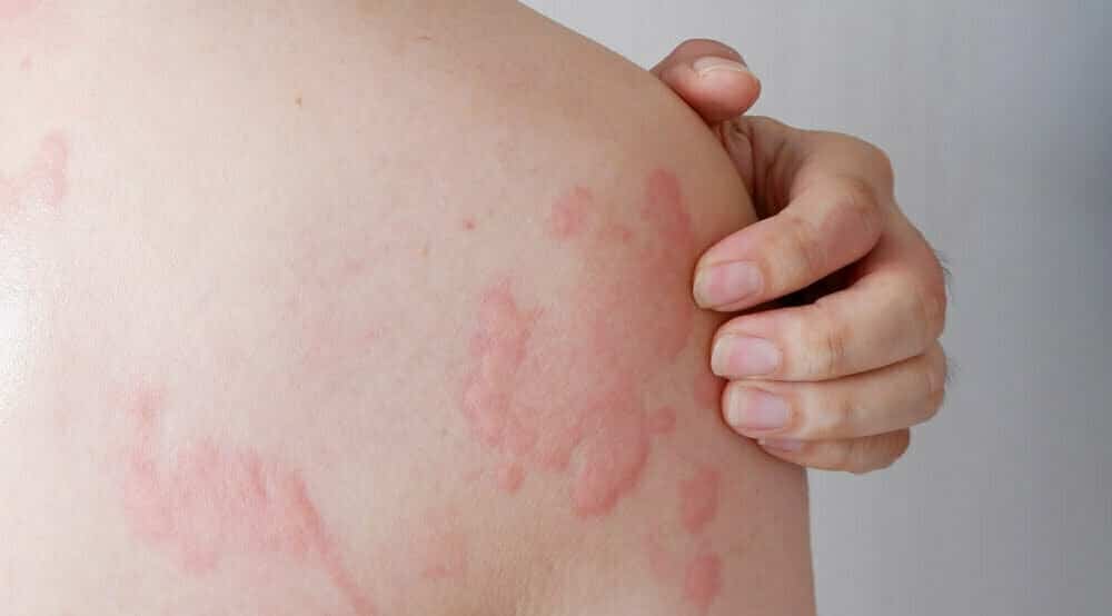 relief from hives urticaria caused by allergies