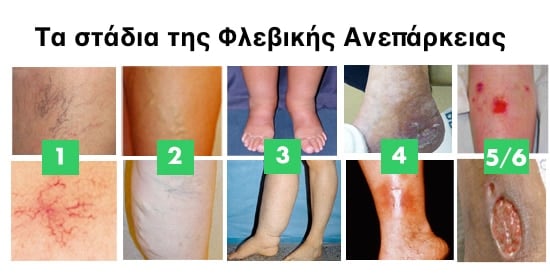 stadia tis flevikis aneparkeias