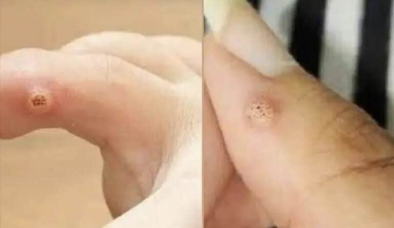 Προσέξτε πολύ: Εάν παρατηρήσετε αυτή τη δερματική αλλοίωση, μπορεί να είναι σοβαρό