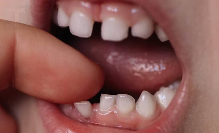 Να γιατί οι γονείς πρέπει να κρατούν τα νεογιλά δόντια του παιδιού τους. Μπορεί να σώσουν μια ζωή