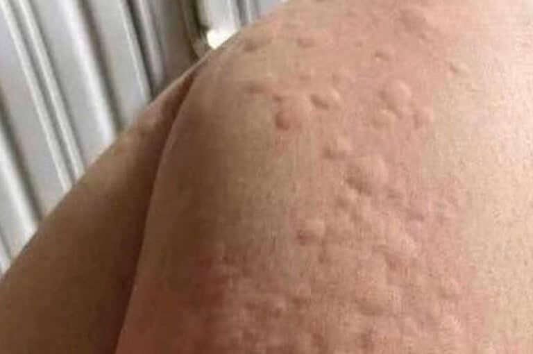 Να είστε προσεκτικοί αν σας τρώει το σώμα και εμφανιστούν αυτά τα εξογκώματα στο δέρμα σας…