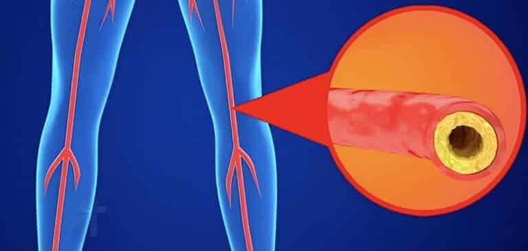 Χοληστερόλη: Τα σημάδια στα πόδια που μαρτυρούν ότι είναι στα ύψη