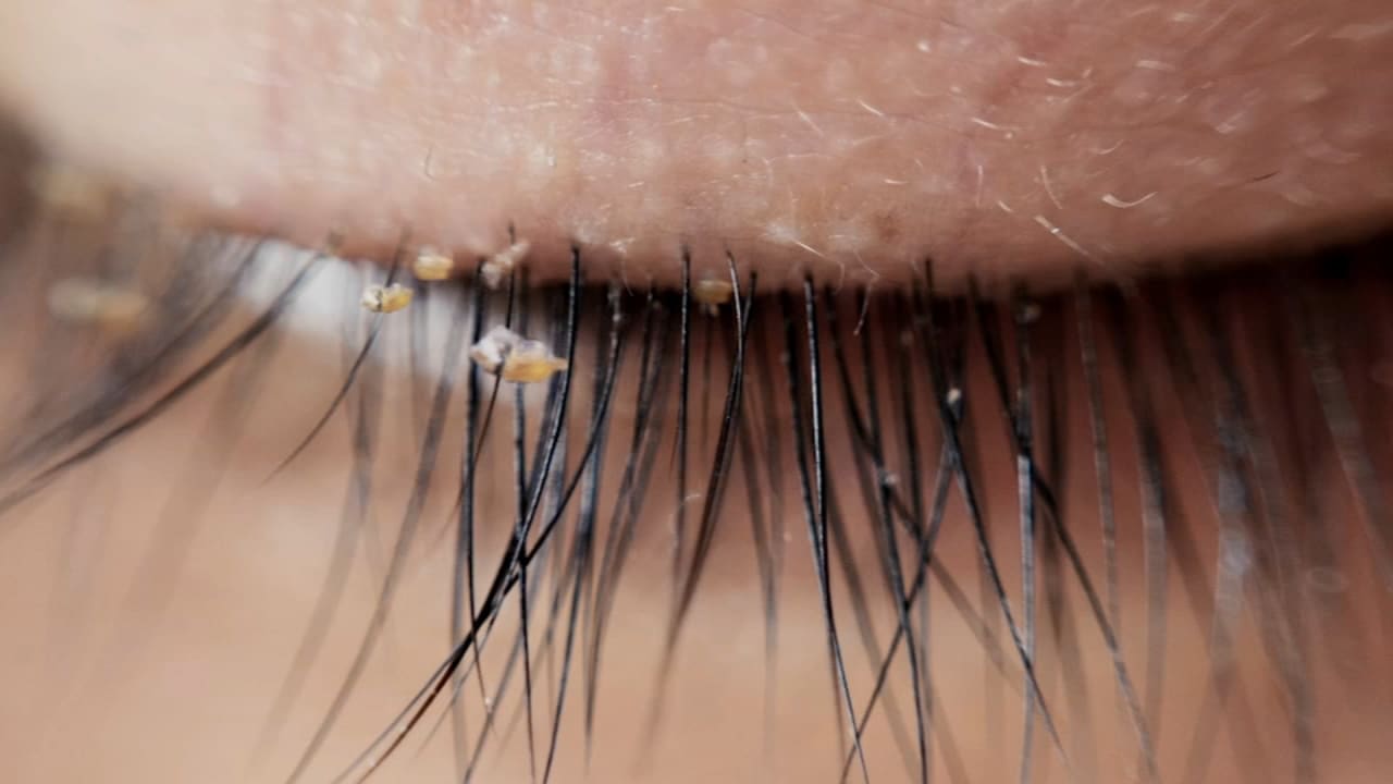 5699208 111519 ewn 6am skn lash lice vid