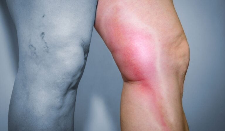 Αuτά τα χάπια μπορεί να προκαλέσουν θρόμβους, πήξεις και έμφραγμα