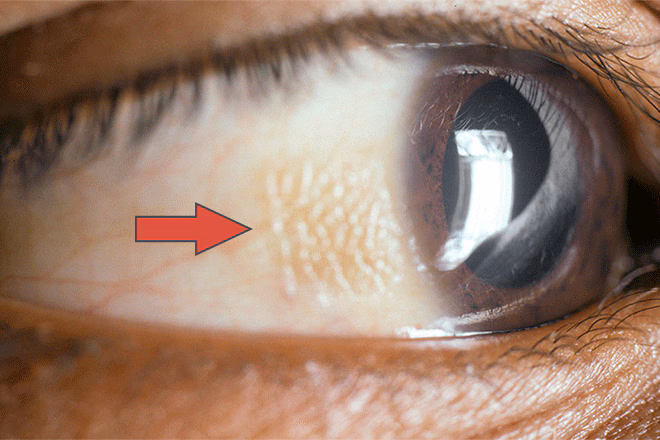 bitot spots 660x440 1