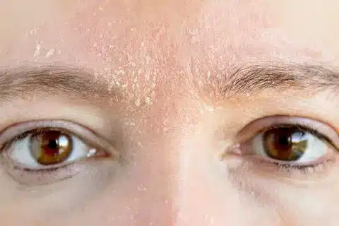 dry dehydrated skin by beauty on rose essendon melbourne
