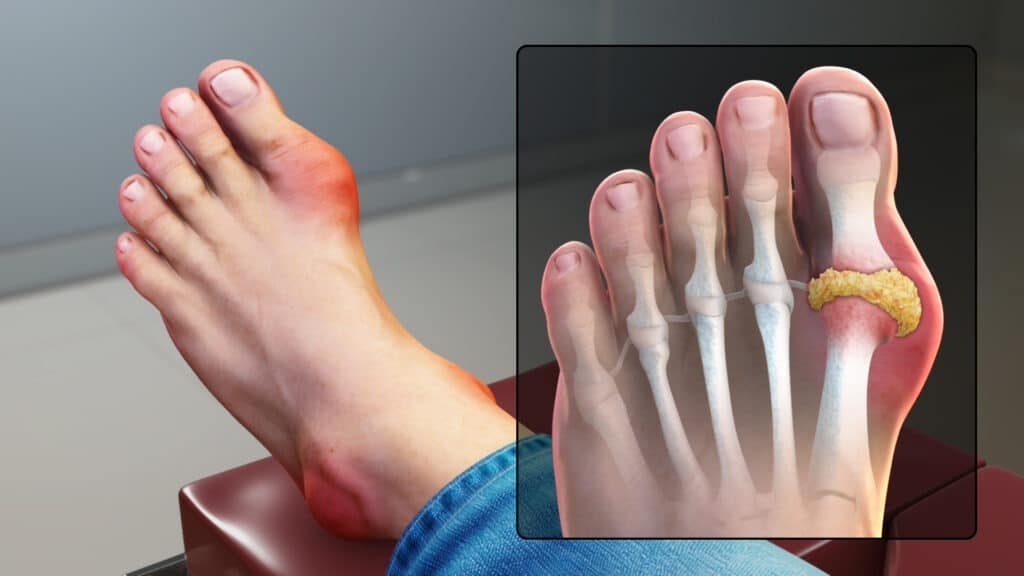 gout signs and symptoms 1024x576 1