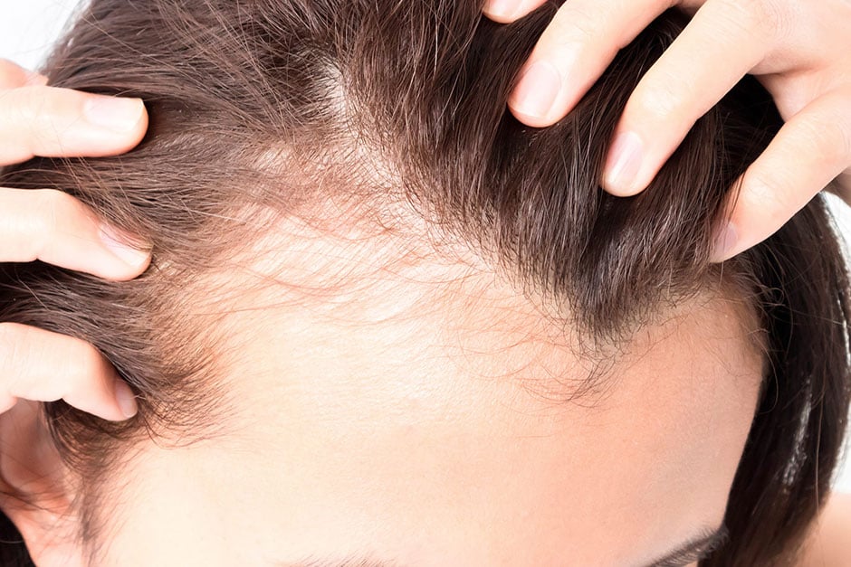 hairlosing woman