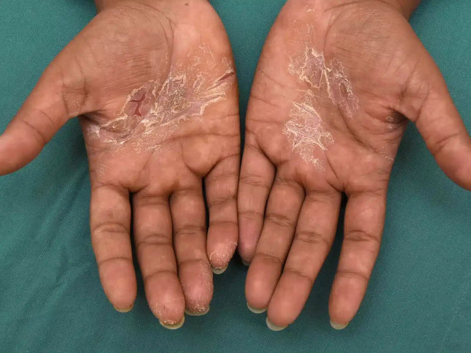 hand dermatitis 00032 compressed scaled.jpg