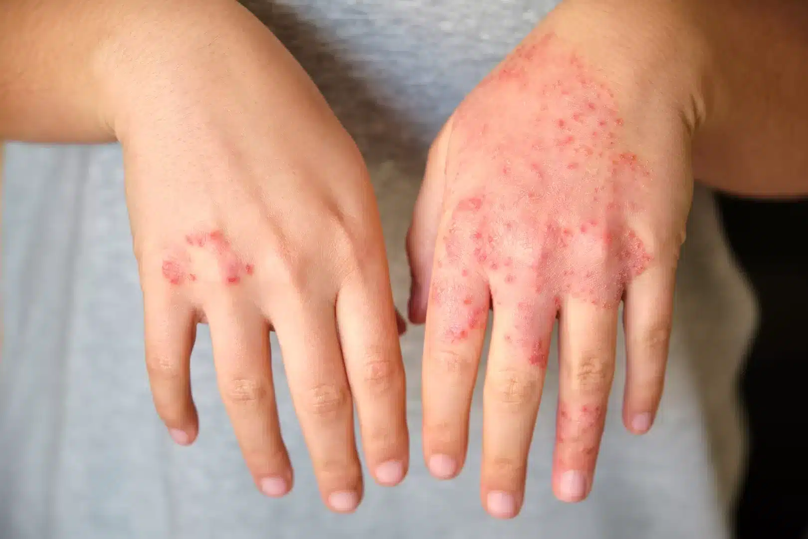 hand eczema banner 1
