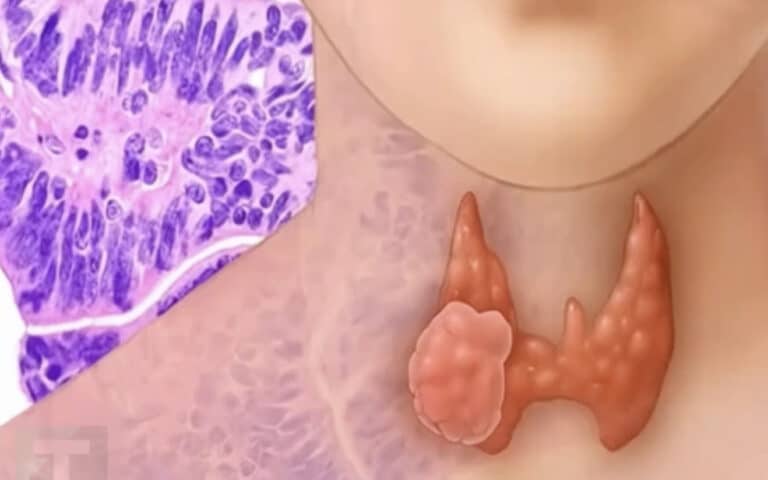 Μια 54χρονη γυναίκα ανακάλυψε ότι είχε καρκίνο του θυρεοειδούς από ένα σημάδι που συχνά περνά απαρατήρητο