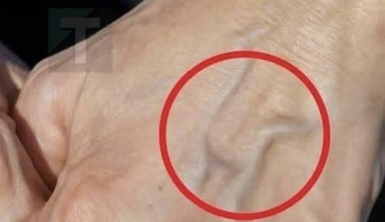 Φυσικές θεραπείες για τη βελτίωση της υγείας των φλεβών και του δέρματός σας
