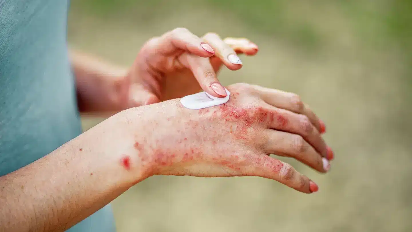what to know about atopic dermatitis on the hands 1440x810 1