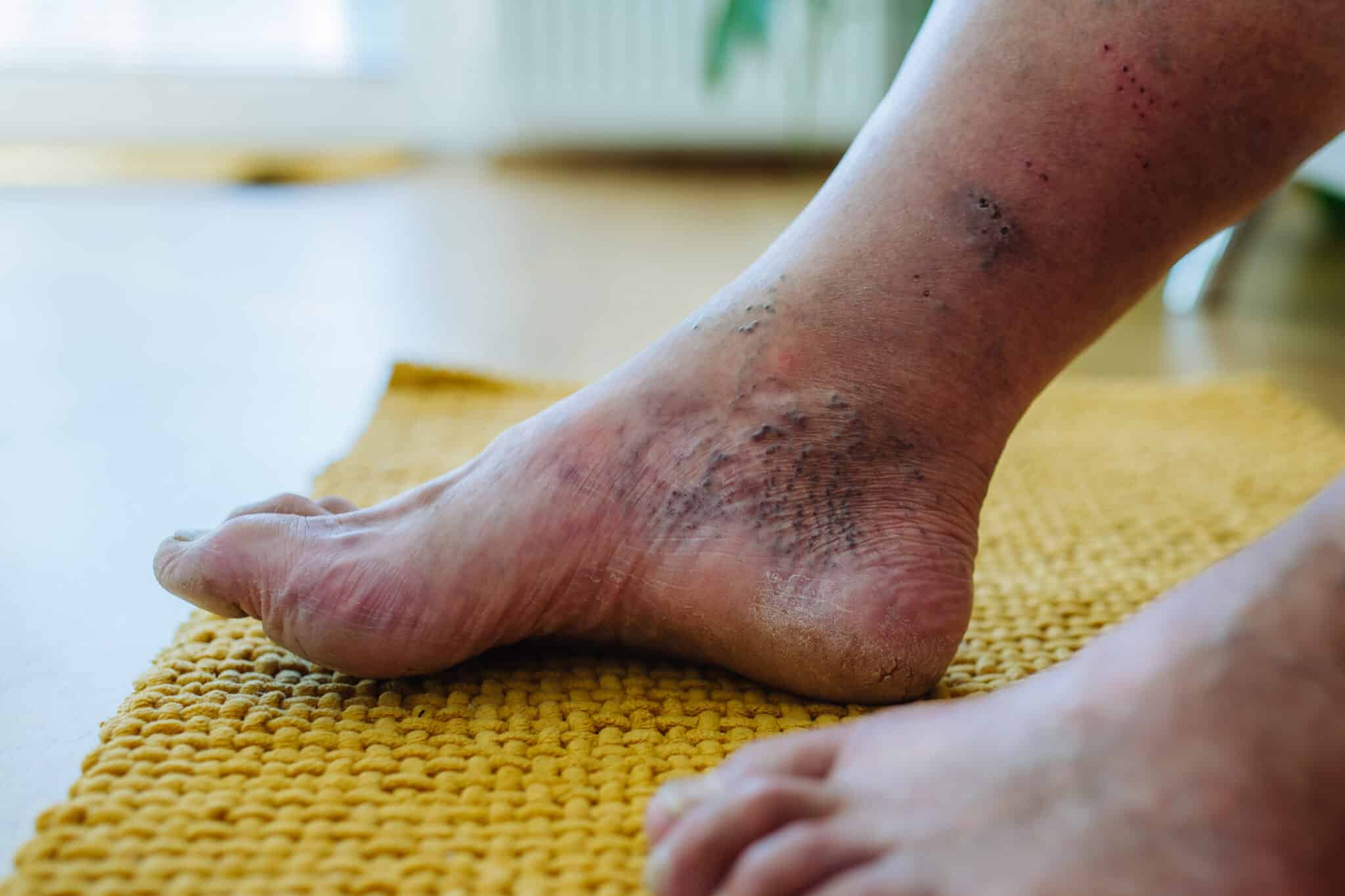 a close up shot of man s feet with diabetic foot c 2023 11 27 05 20 07 utc scaled 1