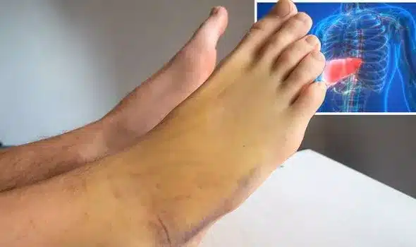 fatty liver disease yellow skin 1415966