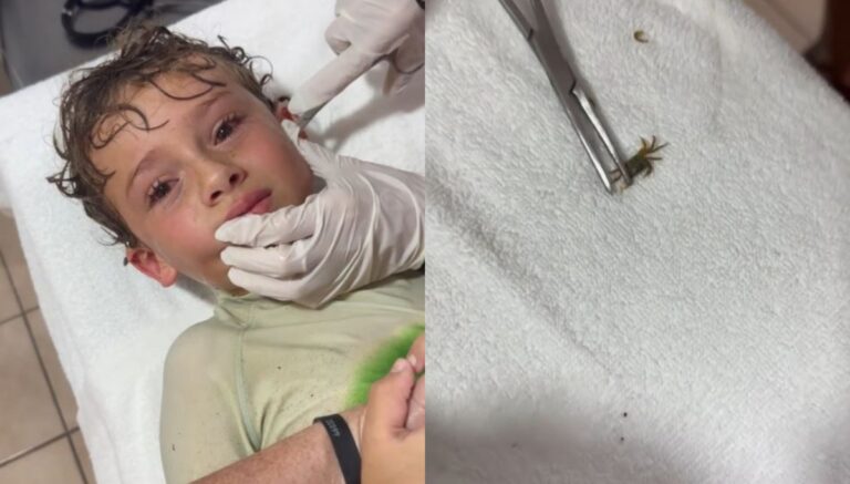 Καβούρι μπήκε στο αυτί ενός αγοριού – Βίντεο από τη στιγμή που οι γιατροί το βγάζουν ζωντανό