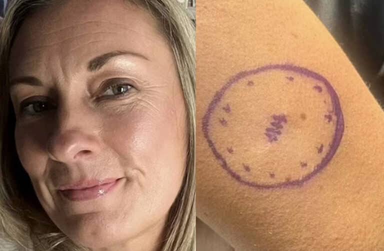 «Είχα μια ελιά τέσσερα χρόνια που εξελίχθηκε σε καρκίνο» – Πώς ήταν ο σπίλος της 46χρονης